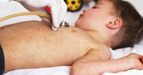 Azərbaycan qızılcanın ləğvi "statusunu" 